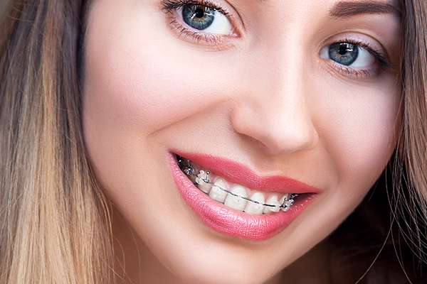 Common Clear Braces Maintenance And Aftercare