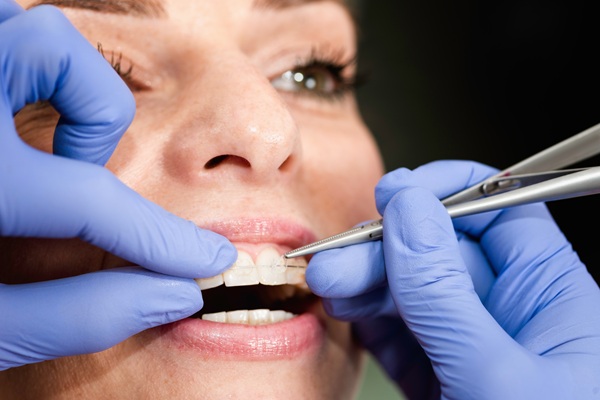 FAQs About Clear Braces Treatment