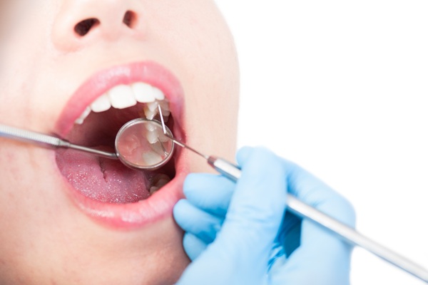 How Composite Fillings And Other Restorations Can Save Your Natural Teeth