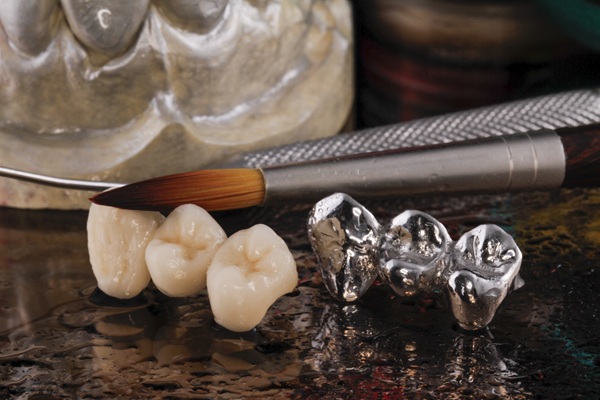 How To Tell If You Are A Candidate For A Dental Bridge