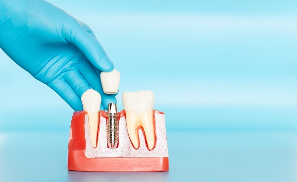 Am I A Candidate For Dental Implants?