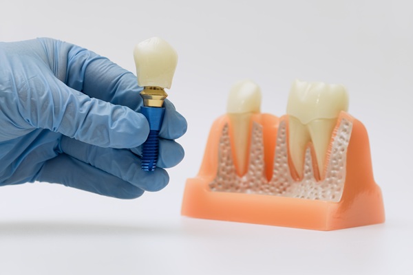 Discover The Lifelong Benefits Of A Dental Implant For Your Oral Health