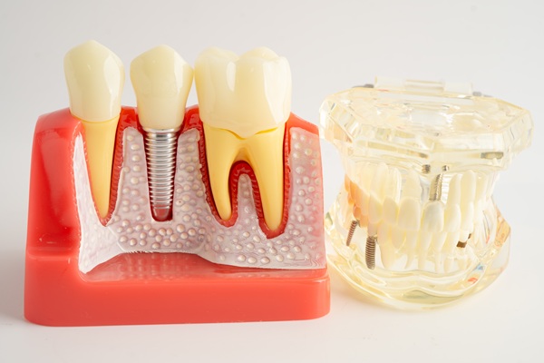 What To Consider When Choosing An Implant Restoration