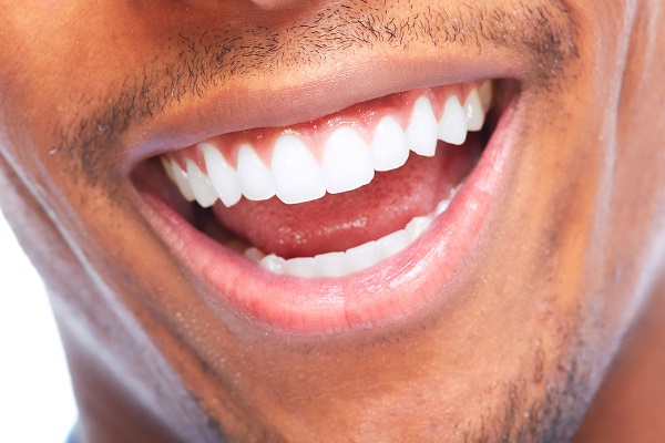 How Long Will The Results Of A Teeth Whitening Smile Makeover Last?